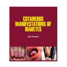 Cutaneous Manifestations of Diabetes